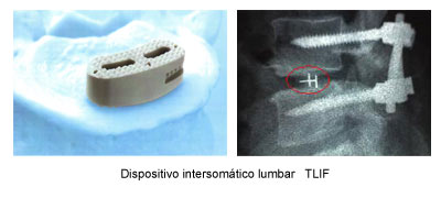   Dispositivo intersomático lumbar   TLIF