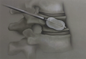 Cifoplastia