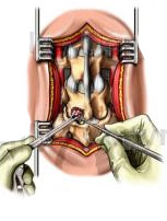 Discectomia dolorespalda.es