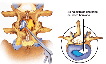 Discectomia dolorespalda.es