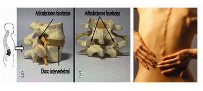 Síndrome facetario Traumatologoslleida.es