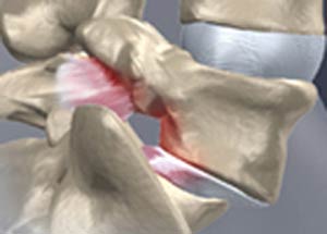 Espondilolistesis