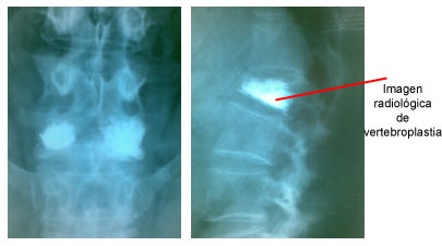 Verebroplastia Dr. Alfredo Charlez