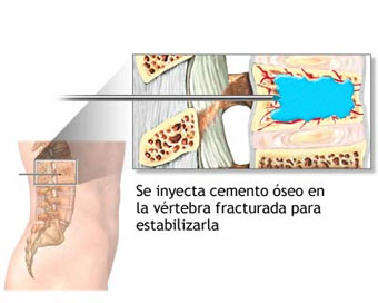 Vertebroplastia dolorespalda.es