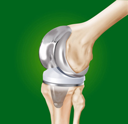 Prtesis de rodilla