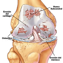 Patologa degenerativa de rodilla