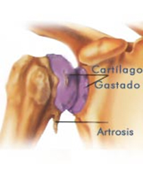 Patologa degenerativa de hombro